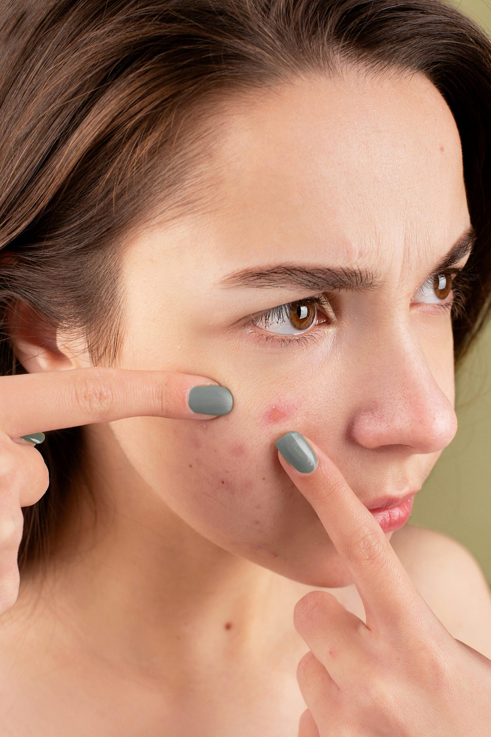 How to Get Rid of Acne: Home Remedies for Pimples