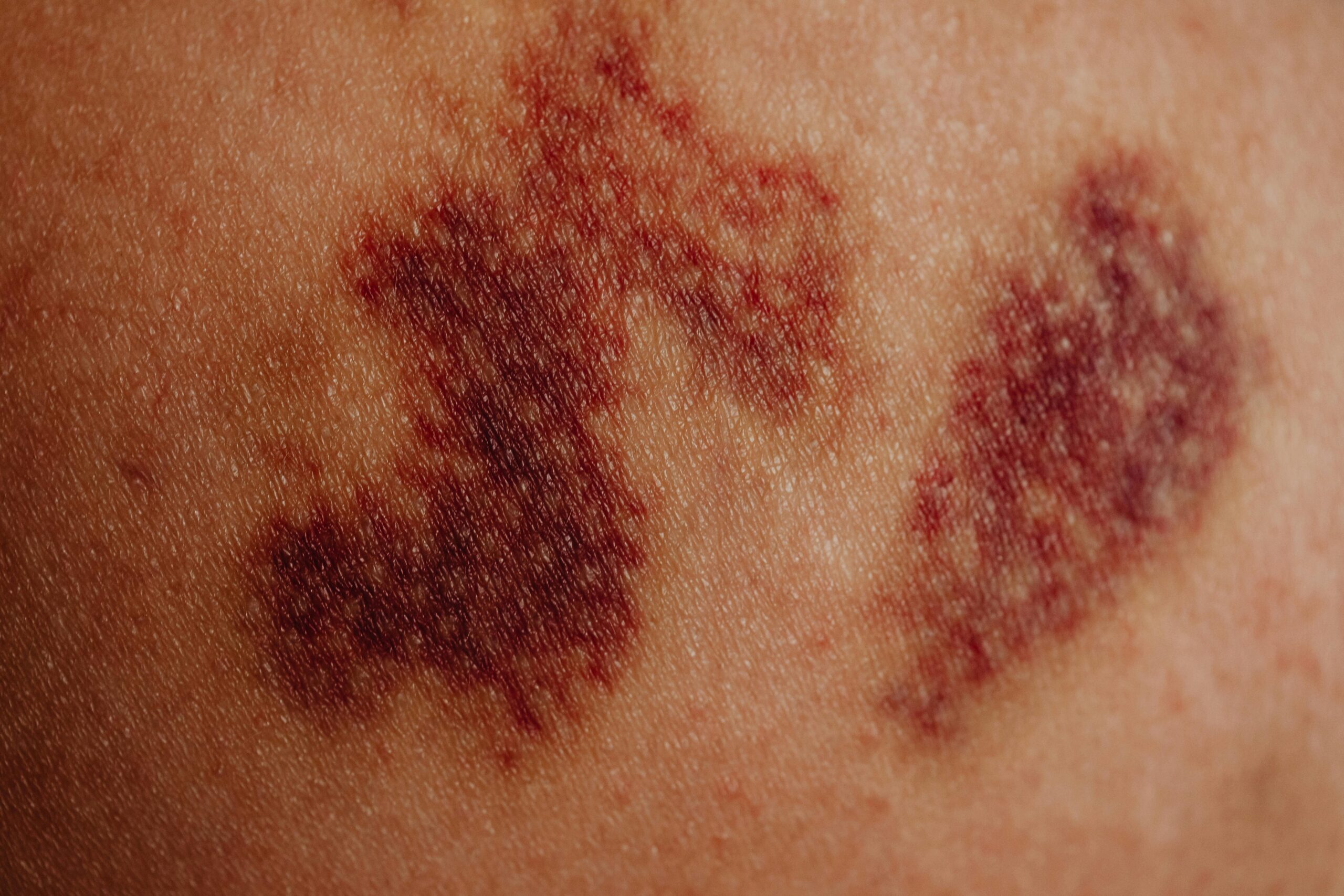 What Causes Urticaria?